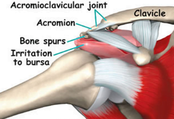 Why Does My Shoulder Hurt When I Lift My Arm? - Arkansas Surgical Hospital