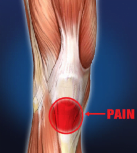 Patella Tendon Pain - Runner's Knee - Align Body Clinic