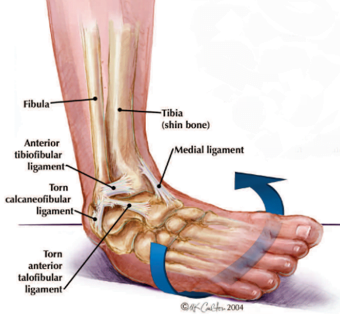 anterior tabulo inversion sprain