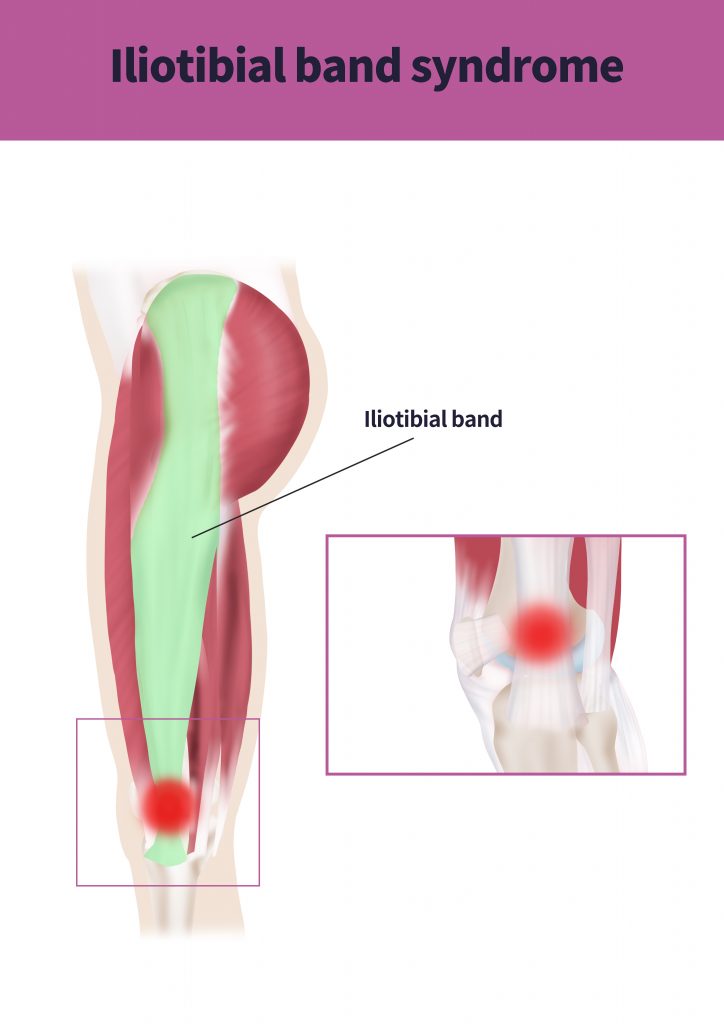 How to Get Rid of IT Band Syndrome - Align Body Clinic